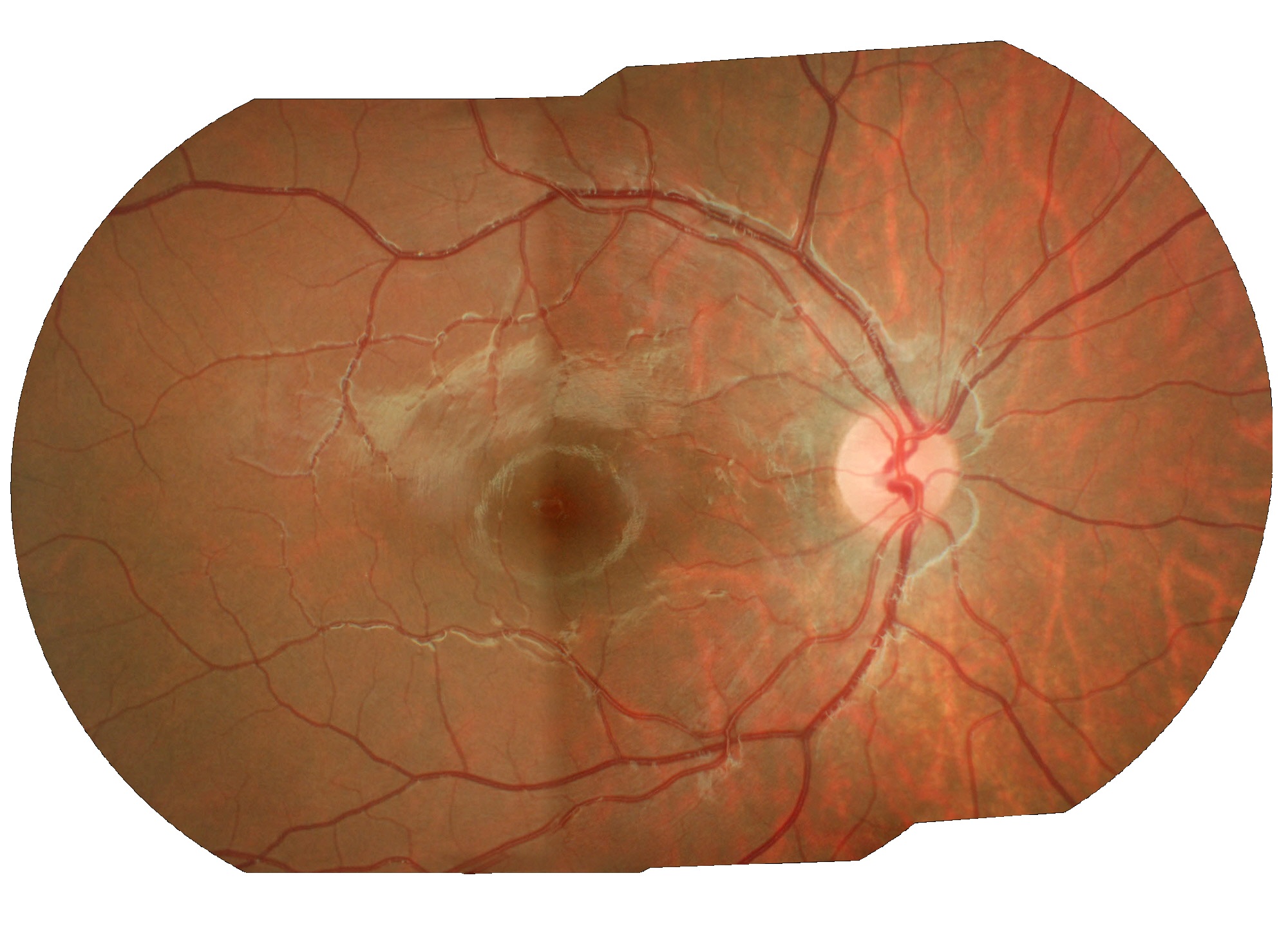 Diabete e retinopatia in et pediatrica